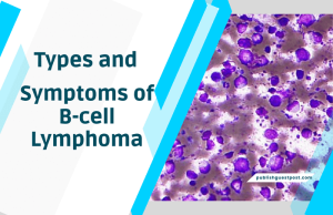 Symptoms of B-cell Lymphoma